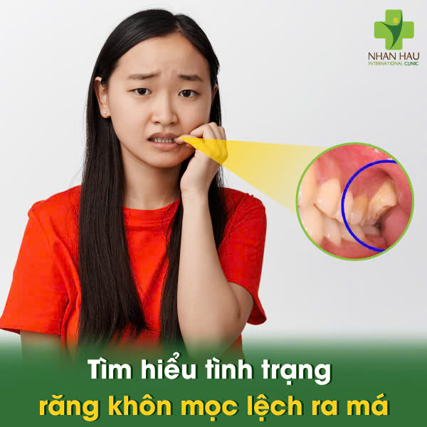 Tìm hiểu tình trạng răng khôn mọc lệch ra má