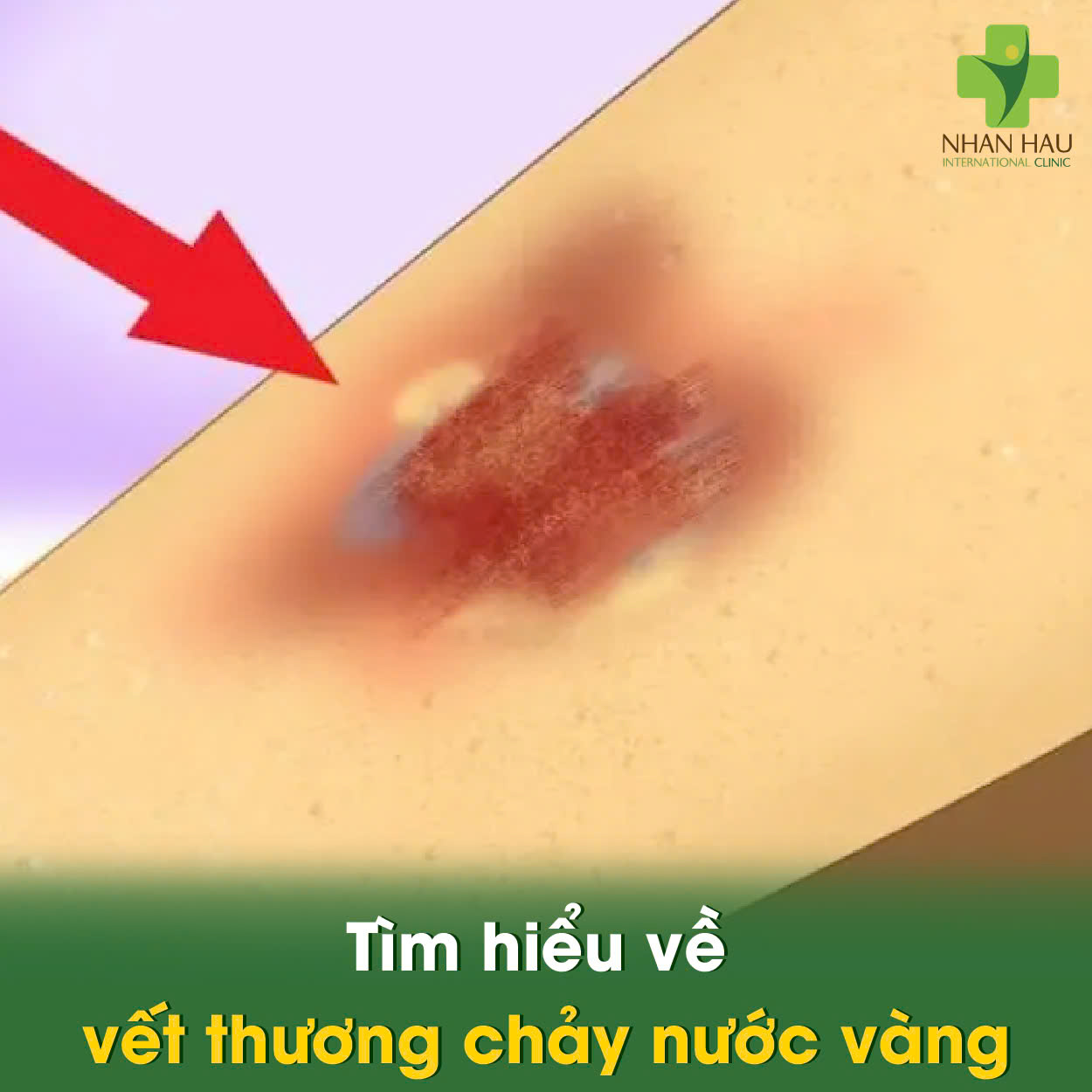 Tìm hiểu về vết thương chảy nước vàng