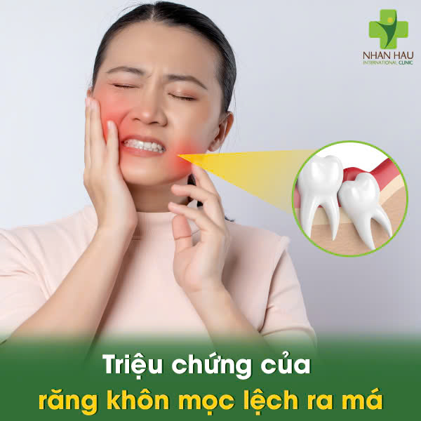 Triệu chứng của răng khôn mọc lệch ra má