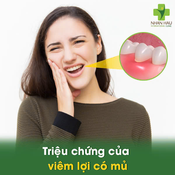 Triệu chứng của viêm lợi có mủ