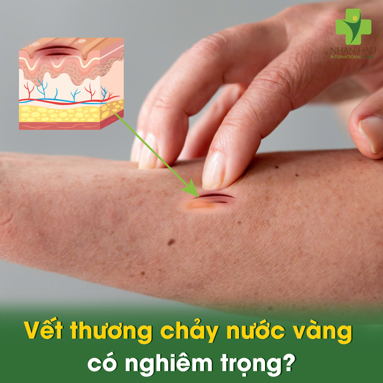 Vết thương chảy nước vàng có nghiêm trọng không?