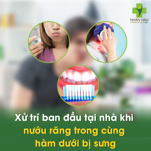 Xử trí ban đầu tại nhà khi nướu răng trong cùng hàm dưới bị sưng