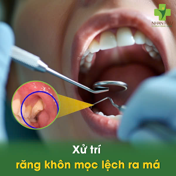 Xử trí răng khôn mọc lệch ra má