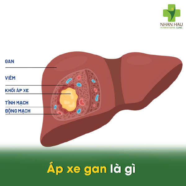 Áp xe gan là gì