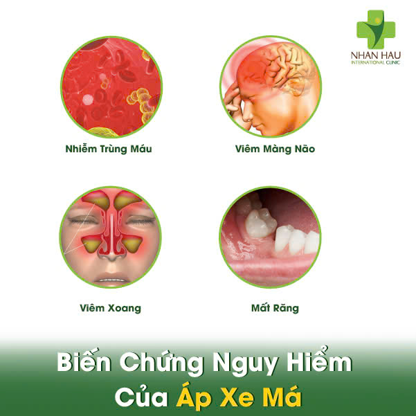 Biến Chứng Nguy Hiểm Của Áp Xe Má