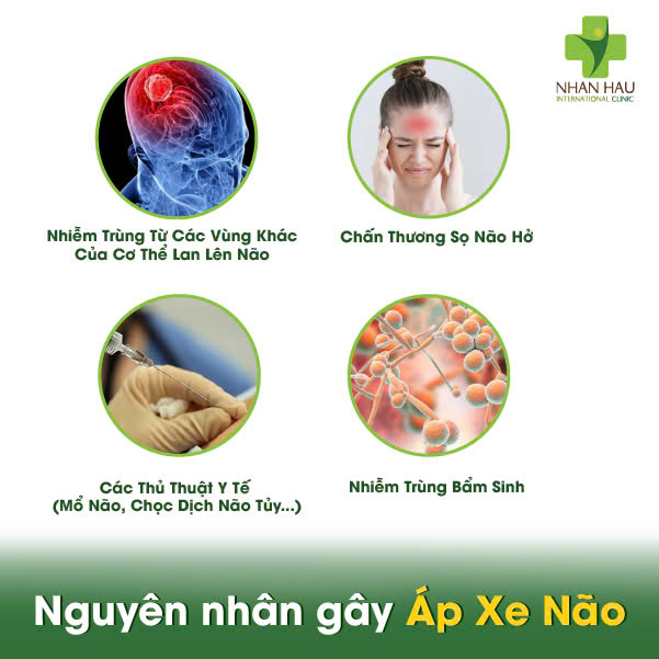 Nguyên Nhân Gây Áp Xe Não