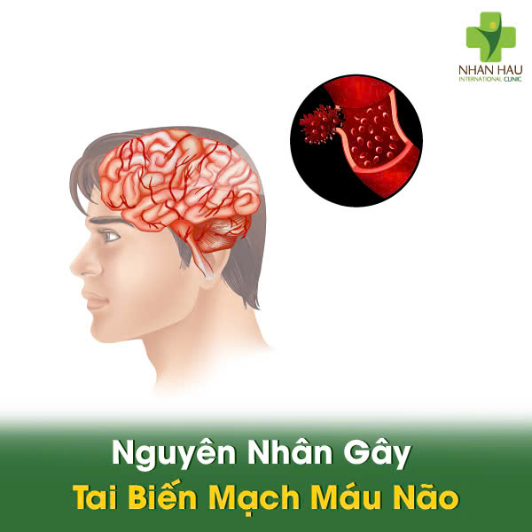 Nguyên Nhân Gây Tai Biến Mạch Máu Não