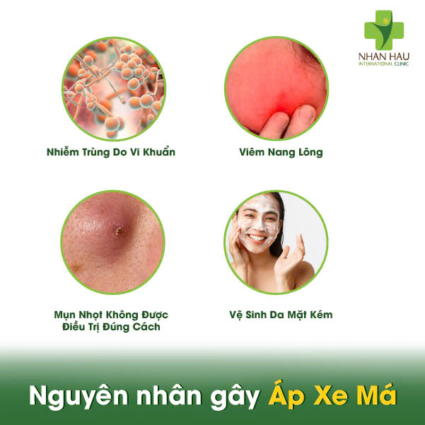 Áp Xe Má: Nhận Biết, Điều Trị, Phòng Ngừa 3 Nguyên nhân gây Áp Xe Má