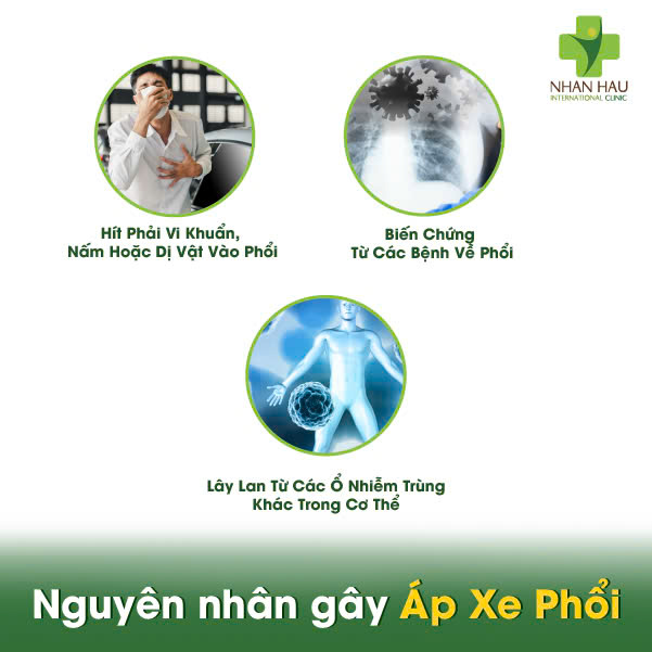 Nguyên nhân gây Áp Xe Phổi