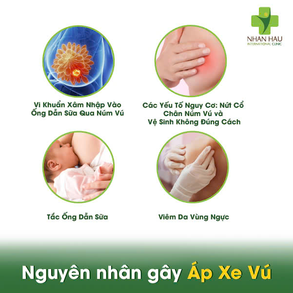 Nguyên nhân gây Áp Xe Vú