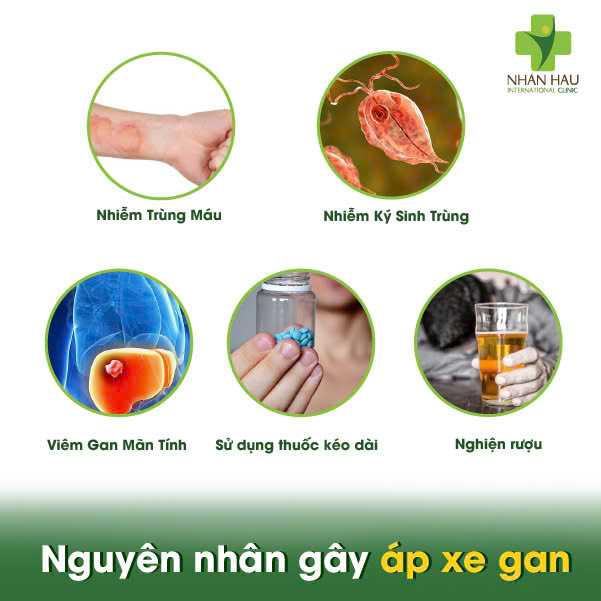 Nguyên nhân gây áp xe gan