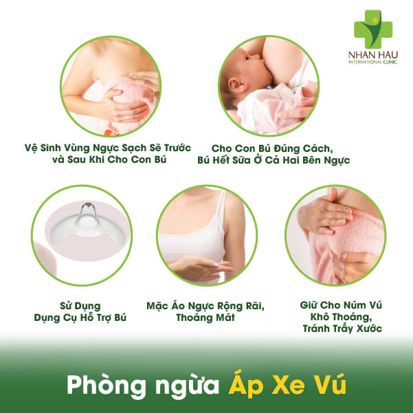 Áp Xe Vú: Triệu Chứng, Nguyên Nhân và Điều Trị 6 Phòng ngừa Áp Xe Vú