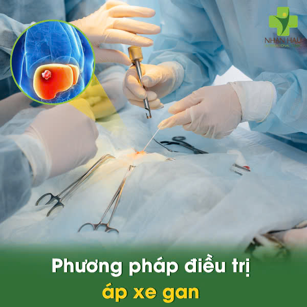 Phương pháp điều trị áp xe gan