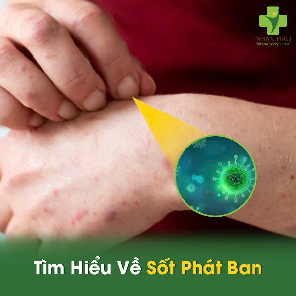 Tìm Hiểu Về Sốt Phát Ban