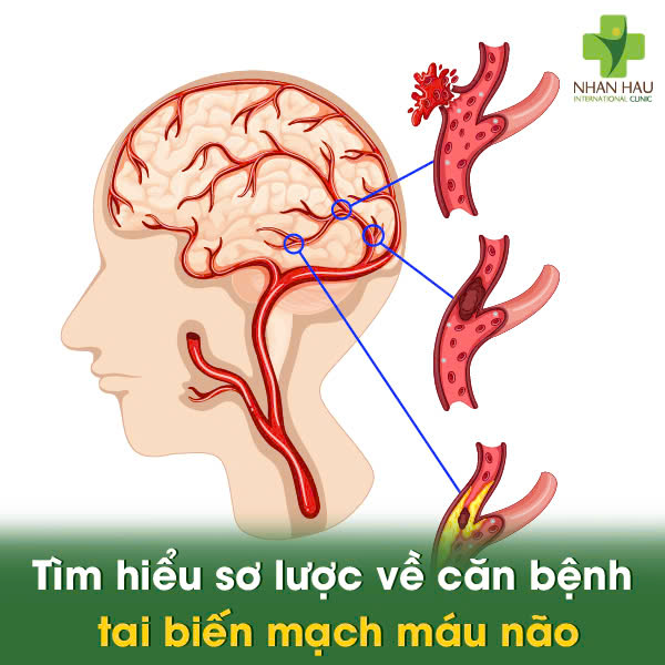 Tìm hiểu sơ lược về căn bệnh tai biến mạch máu não