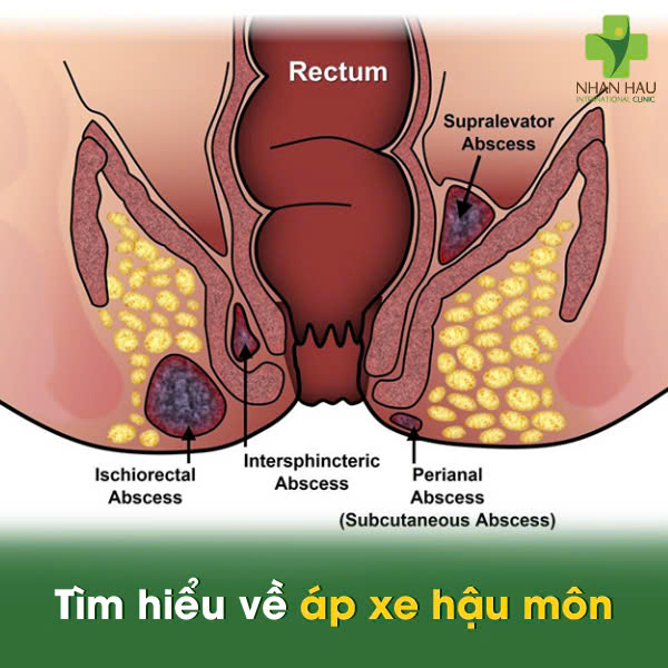 Tìm hiểu về áp xe hậu môn