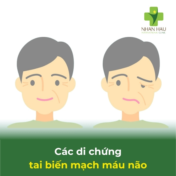 các di chứng tai biến mạch máu não thường gặp