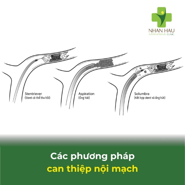 phương pháp can thiệp nội mạch