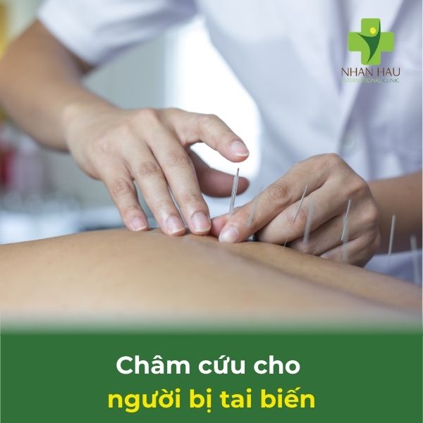 châm cứu cho người bị tai biến mạch máu não