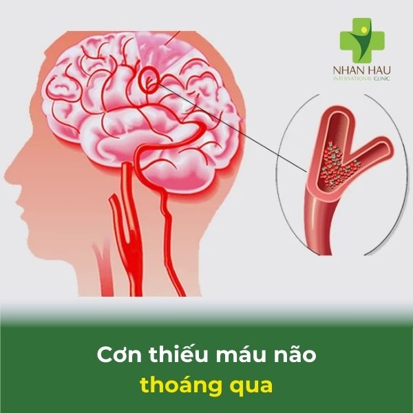 cơn thiếu máu não thoáng qua