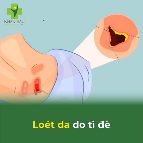 biến chứng loét da do tì đè lâu