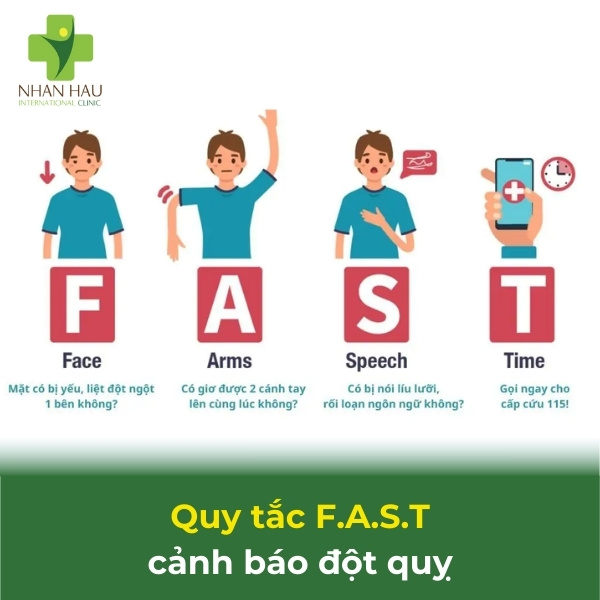 Quy tắc FAST cảnh báo đột quỵ