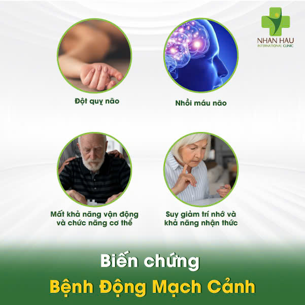 Biến chứng Bệnh Động Mạch Cảnh