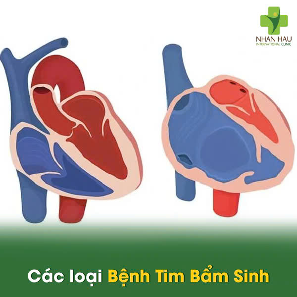 Các loại Bệnh Tim Bẩm Sinh