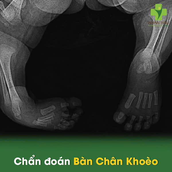 Chẩn đoán Bàn Chân Khoèo