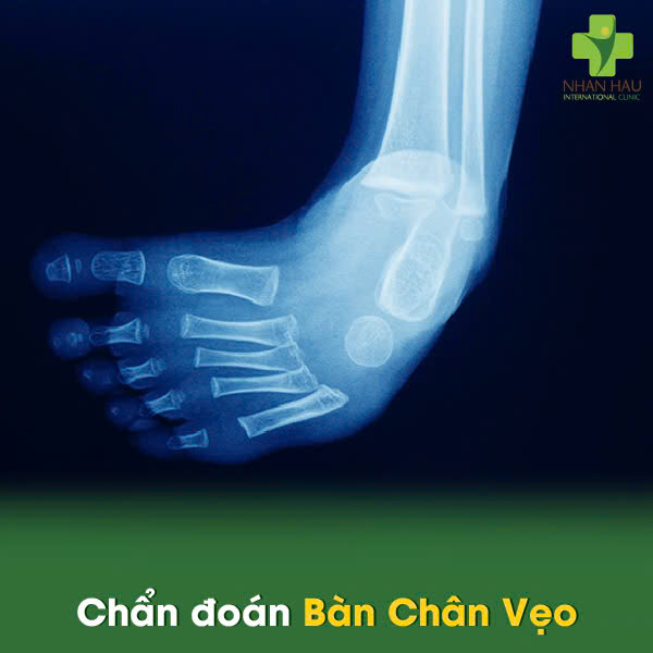 Chẩn đoán Bàn Chân Vẹo