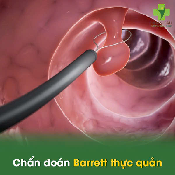 Chẩn đoán Barrett thực quản