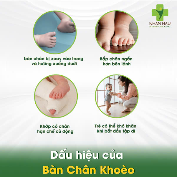 Dấu hiệu của Bàn Chân Khoèo