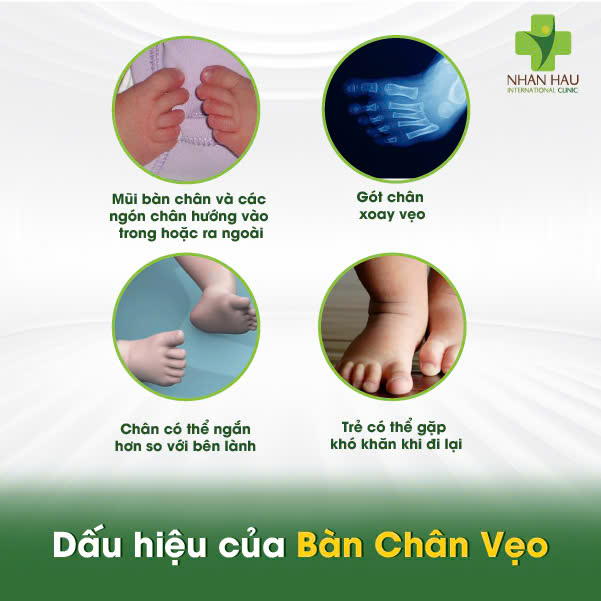 Dấu hiệu của Bàn Chân Vẹo