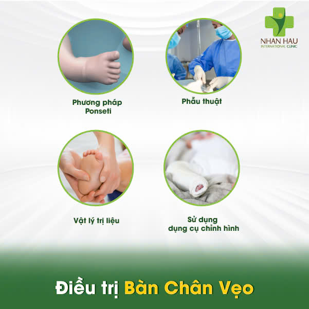 Điều trị Bàn Chân Vẹo