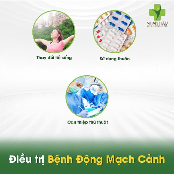 Điều trị Bệnh Động Mạch Cảnh