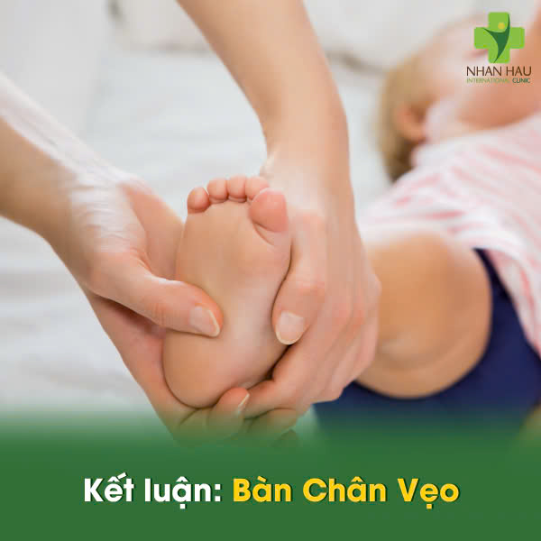 Kết luận: Bàn Chân Vẹo