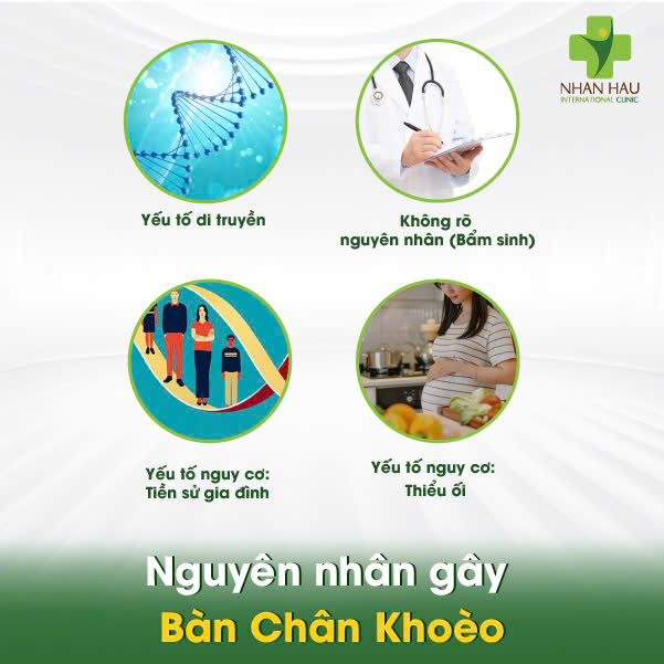 Nguyên nhân gây Bàn Chân Khoèo