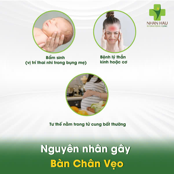 Nguyên nhân gây Bàn Chân Vẹo