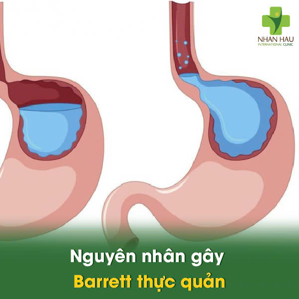 Nguyên nhân gây Barrett thực quản