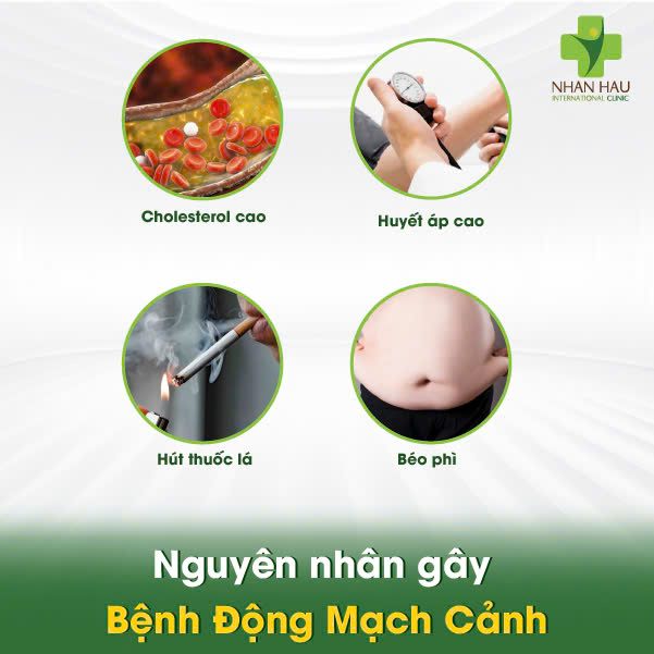 Nguyên nhân gây Bệnh Động Mạch Cảnh