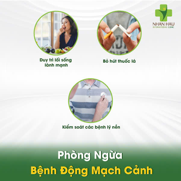 Phòng Ngừa Bệnh Động Mạch Cảnh