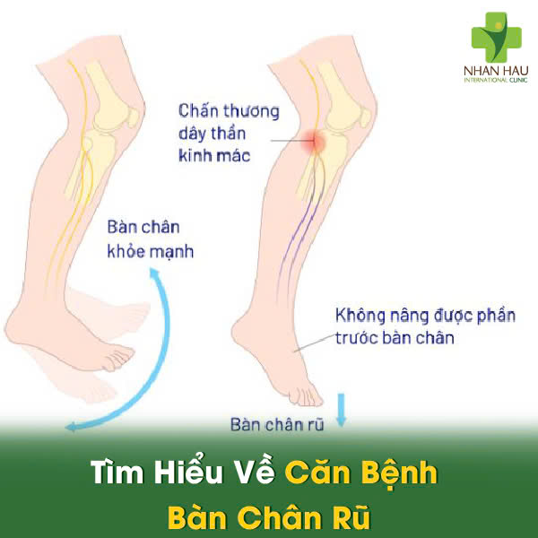 Tìm Hiểu Về Căn Bệnh Bàn Chân Rũ