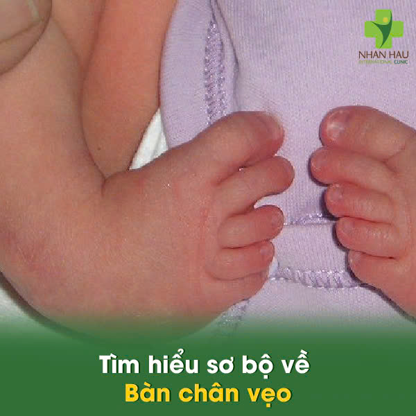 Tìm hiểu sơ bộ về Bàn chân vẹo