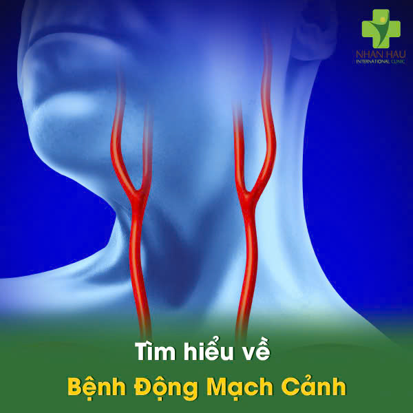 Tìm hiểu về Bệnh Động Mạch Cảnh