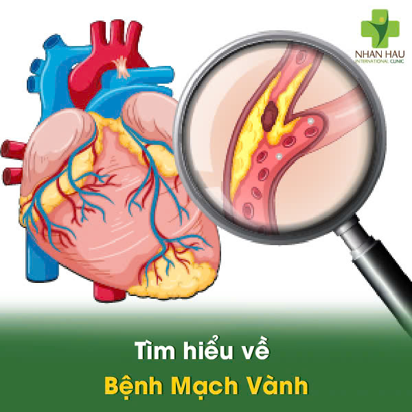 Tìm hiểu về Bệnh Mạch Vành