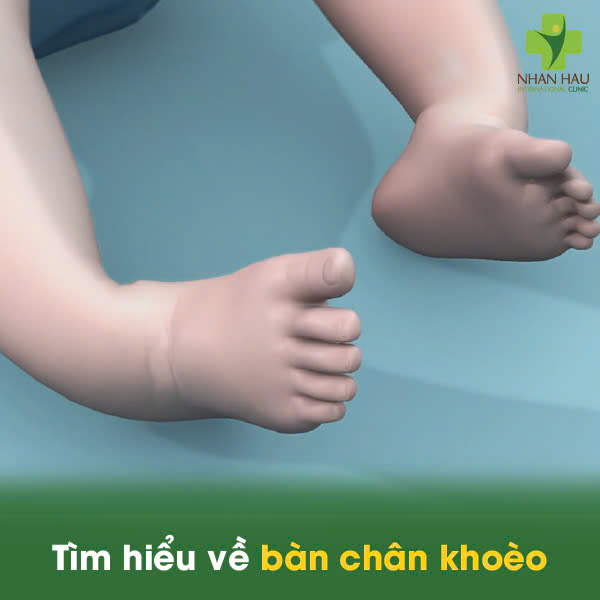 Tìm hiểu về bàn chân khoèo