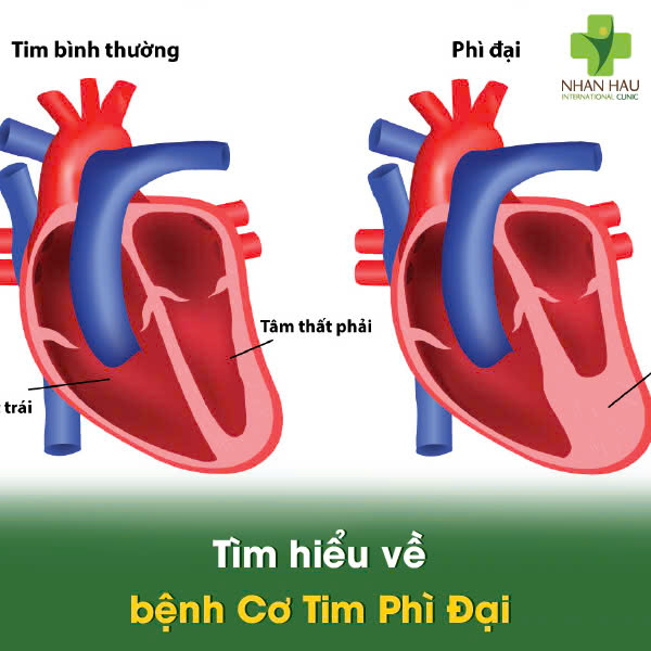 Tìm hiểu về bệnh Cơ Tim Phì Đại