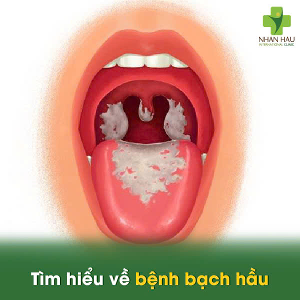 Tìm hiểu về bệnh bạch hầu