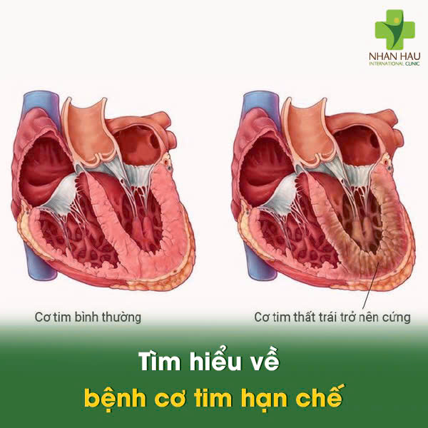 Tìm hiểu về bệnh cơ tim hạn chế