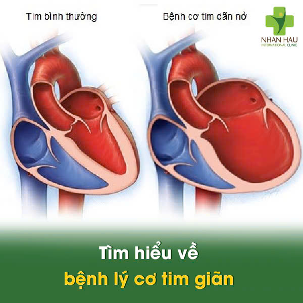 Tìm hiểu về bệnh lý cơ tim giãn